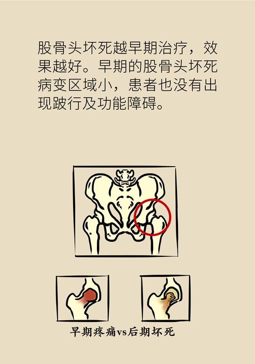 激素會帶來股骨頭壞死的后遺癥嗎？