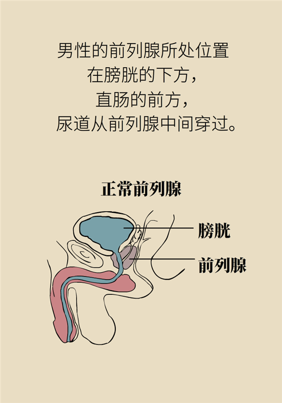 前列腺肥大了還能縮小嗎？