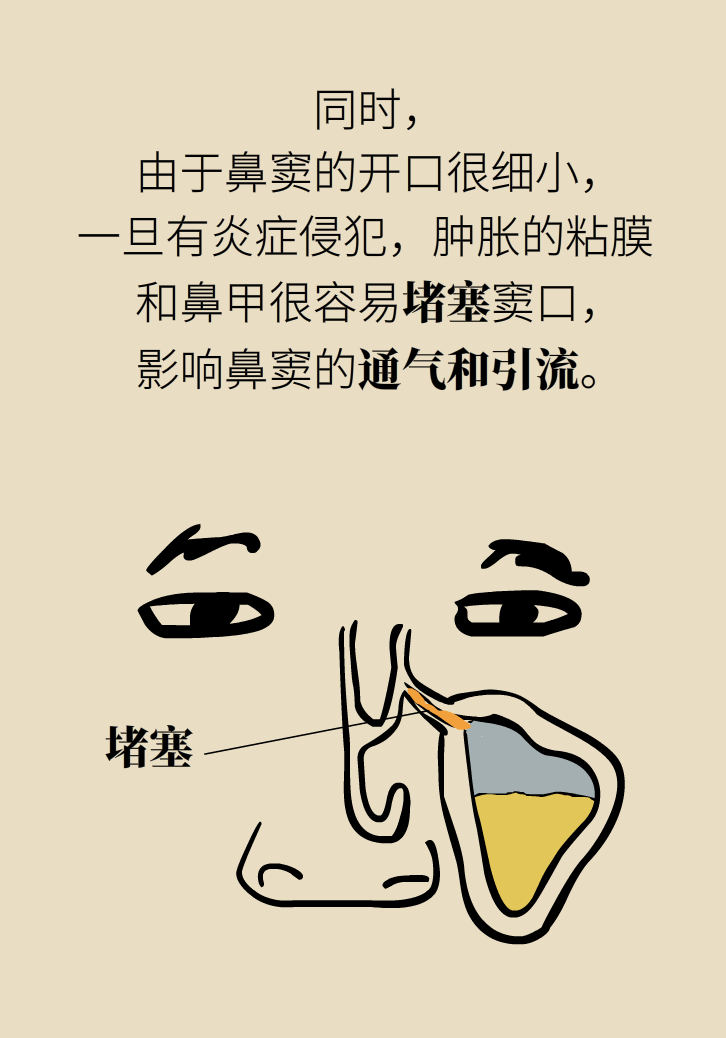 為什么鼻竇發(fā)炎，疼的卻是頭、眼和牙？