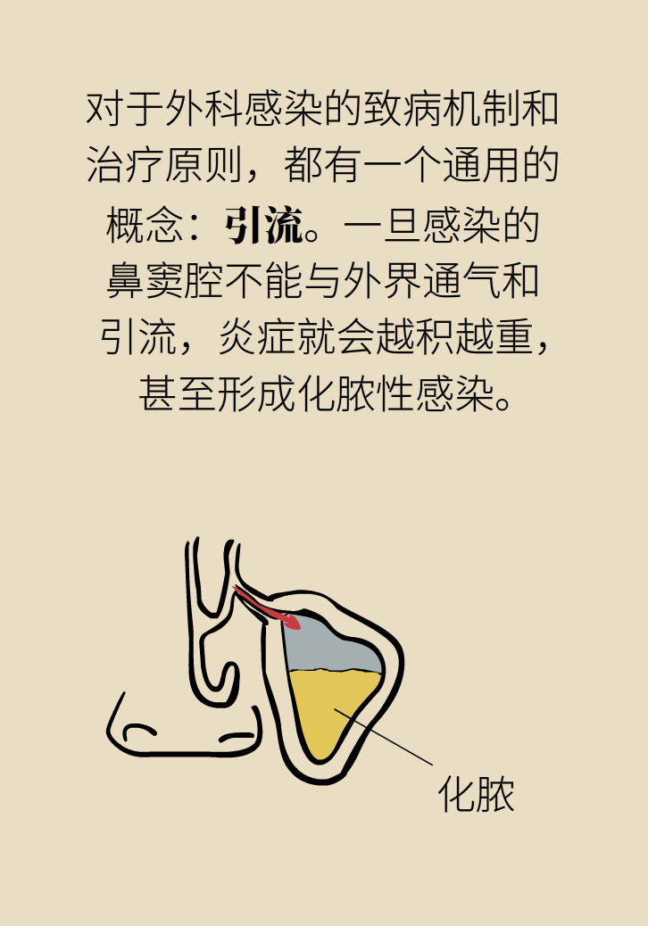 為什么鼻竇發(fā)炎，疼的卻是頭、眼和牙？