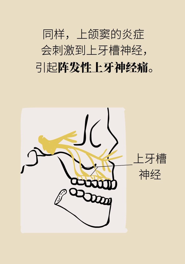 為什么鼻竇發(fā)炎，疼的卻是頭、眼和牙？