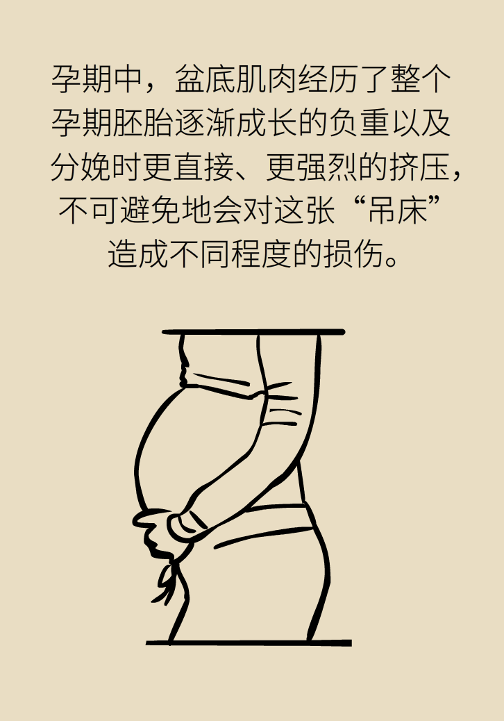 選擇剖腹產(chǎn)，就能避免盆底肌損傷嗎？