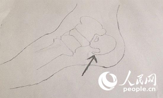 腿腳疼痛就買膏藥治骨刺？別被不良商家誤導了