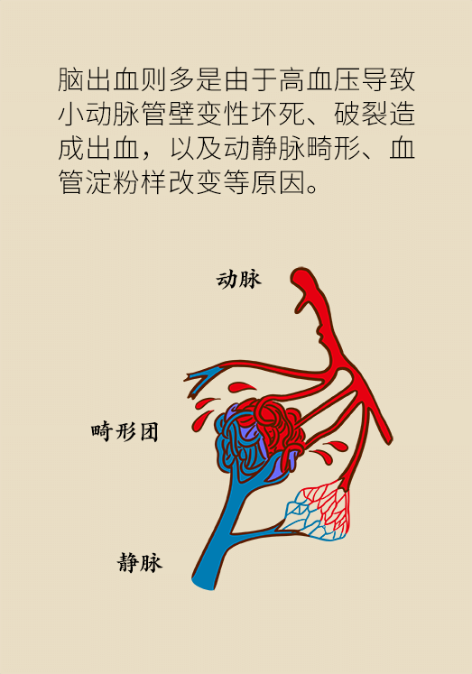 腦出血怎么辦？這些人群要格外注意