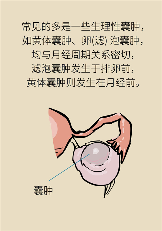 卵巢囊腫科普動漫：卵巢囊腫是腫瘤嗎？要學會這樣區(qū)分