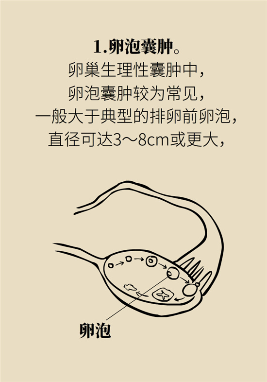 卵巢囊腫科普動漫：卵巢囊腫是腫瘤嗎？要學會這樣區(qū)分