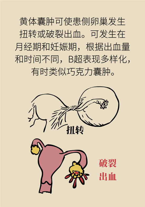 卵巢囊腫科普動漫：卵巢囊腫是腫瘤嗎？要學會這樣區(qū)分