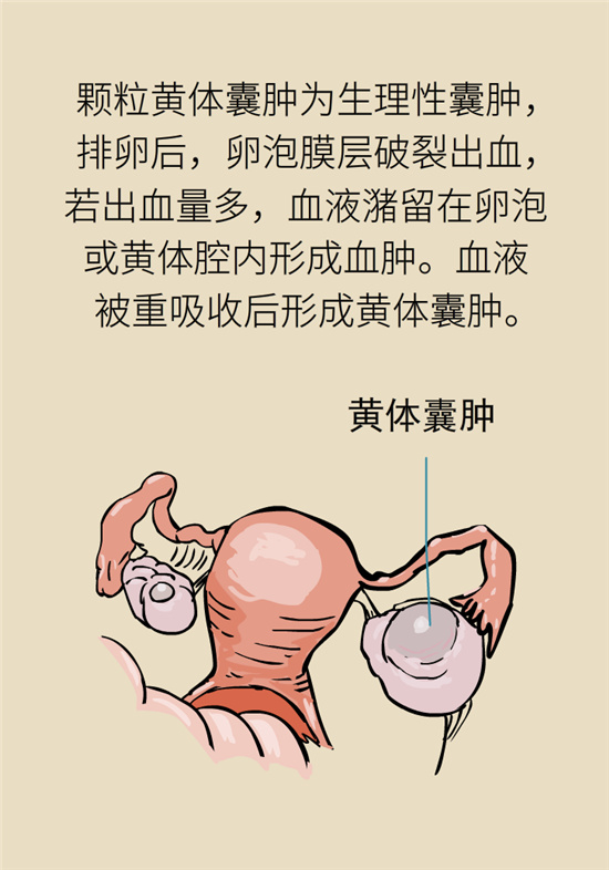 卵巢囊腫科普動漫：卵巢囊腫是腫瘤嗎？要學會這樣區(qū)分