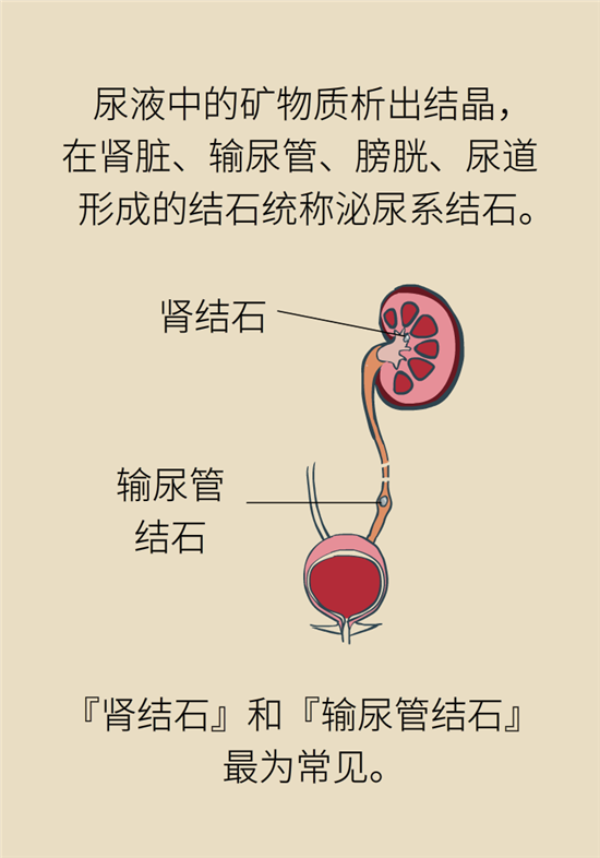 結(jié)石科普：身體里多了各種結(jié)石，應(yīng)該怎么辦？