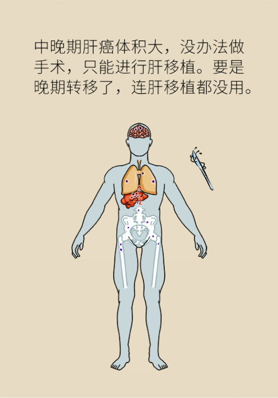 論發(fā)現(xiàn)早期肝癌的本事，cfDNA比AFP更精準(zhǔn)，比影像學(xué)更早一步