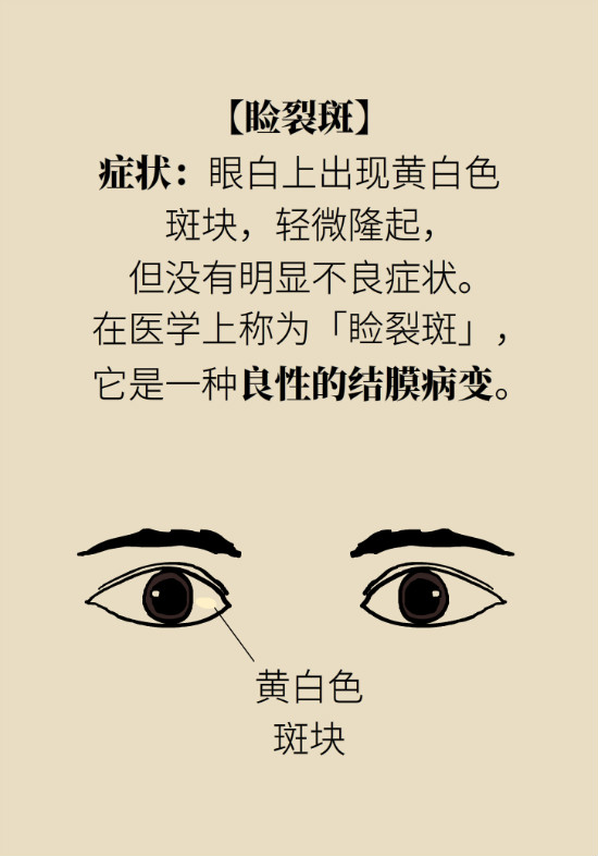 眼白有斑塊、出血要緊嗎？專家：名字唬人但問題不大