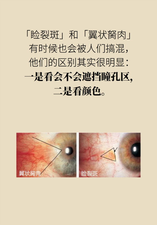 眼白有斑塊、出血要緊嗎？專家：名字唬人但問題不大