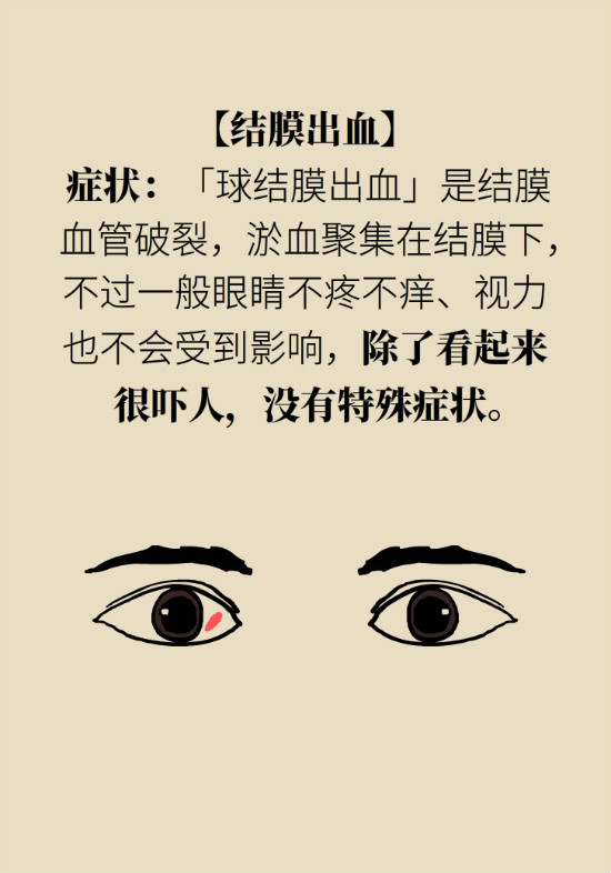 眼白有斑塊、出血要緊嗎？專家：名字唬人但問題不大