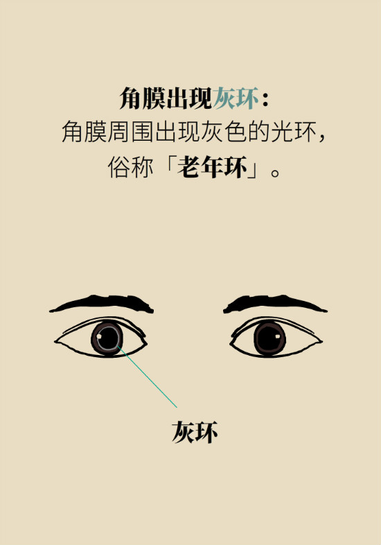 眼白有斑塊、出血要緊嗎？專家：名字唬人但問題不大