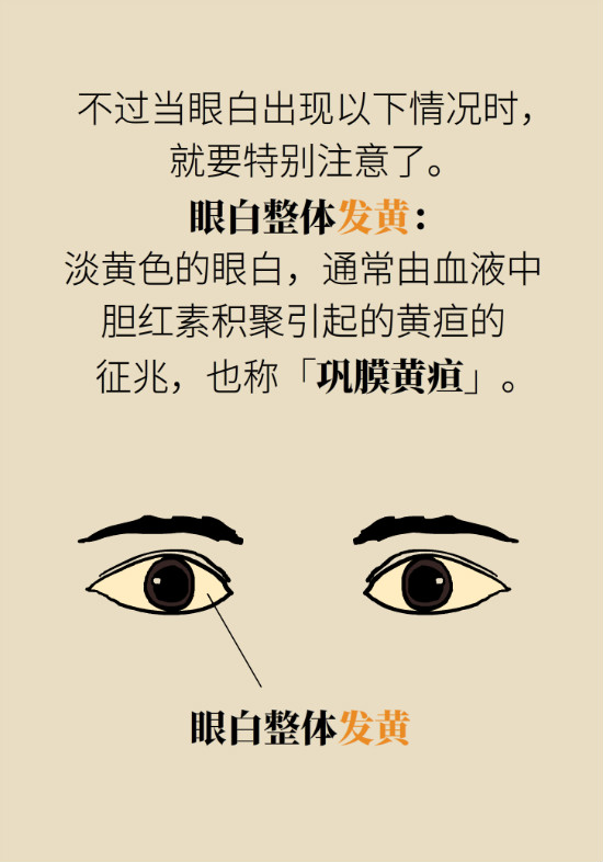 眼白有斑塊、出血要緊嗎？專家：名字唬人但問題不大