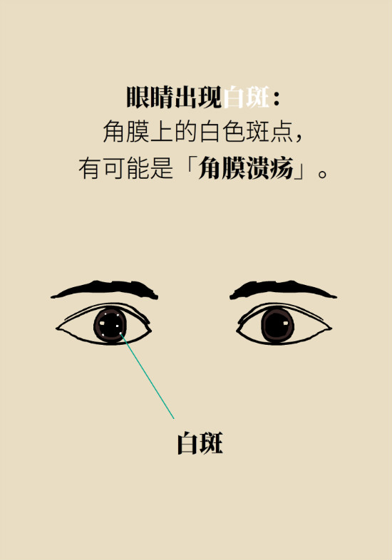 眼白有斑塊、出血要緊嗎？專家：名字唬人但問題不大