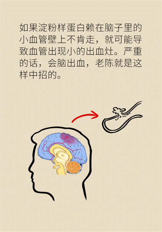 身體出現(xiàn)這些癥狀要小心，可能是腦出血發(fā)出的信號