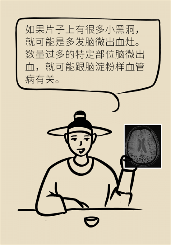 身體出現(xiàn)這些癥狀要小心，可能是腦出血發(fā)出的信號