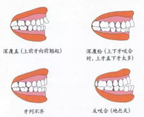 兒童換牙常見(jiàn)3大問(wèn)題，保護(hù)牙齒需要做好這5點(diǎn)