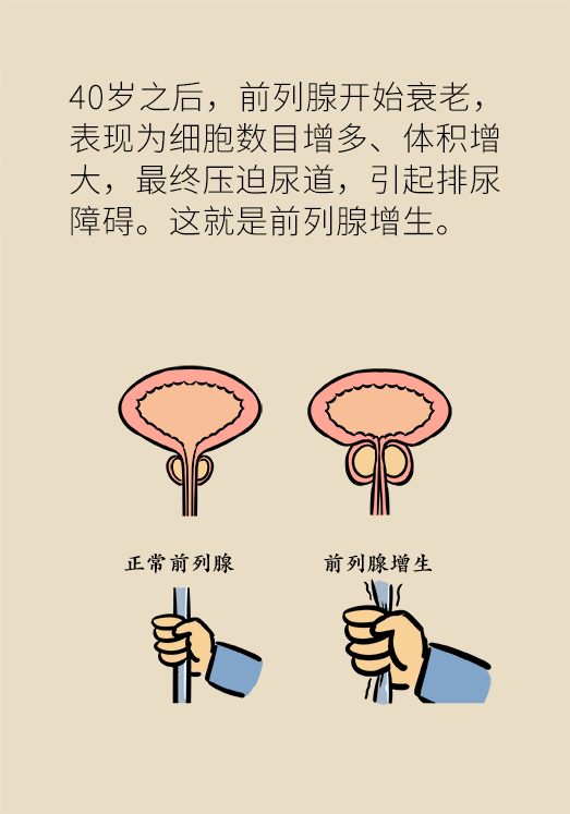 前列腺醫(yī)學(xué)知識(shí)科普