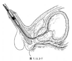 經(jīng)尿道前列腺切除術(shù)