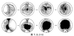 經(jīng)尿道前列腺切除術(shù)